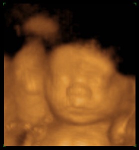 Baby A 25wk 3