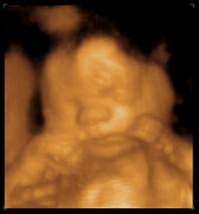 Baby A 25wk 2