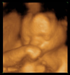 Baby A 25wk 1